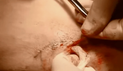 rodzaje operacji usuwania żylaków