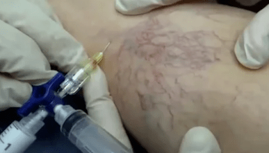 skleroterapia żylaków